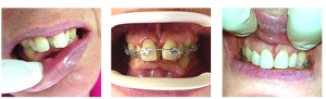 Fast braces orthodontics
