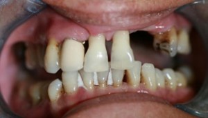 Aldridge Dental Implants Before