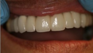 Aldridge Finished Dental Implant Case