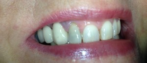 Internal Tooth Whitening in Aldridge Before