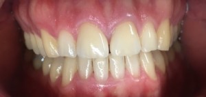 Veneers Aldridge After