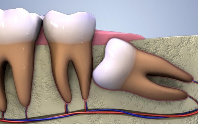  emergency wisdom tooth extraction