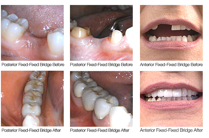 cosmetic bridgework in the West Midlands