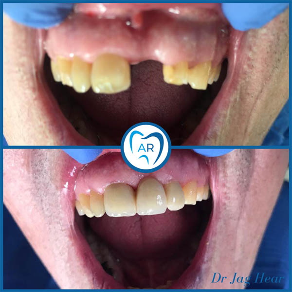 Dental Bridge Before & After 1