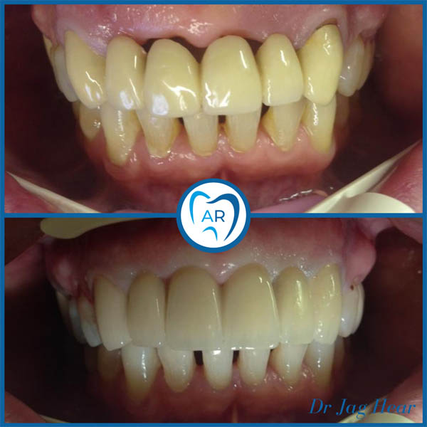 Dental Bridge Before & After 2