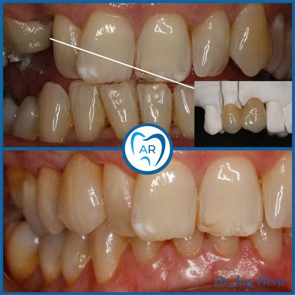 Dental Bridge before and after 4 Walsall