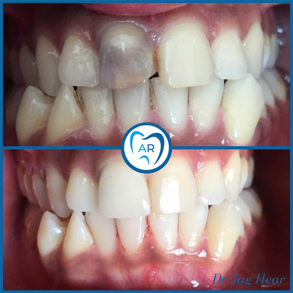 Dental Crown Before & After 1