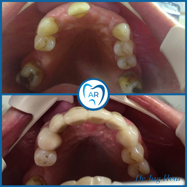 Dental Implant before and after 2 Walsall