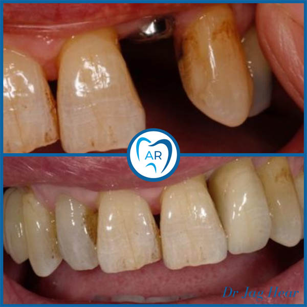 Dental Implant before and after 3 Walsall