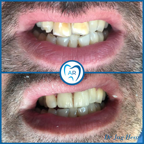 Dental Veneers Before & After 1 Walsall