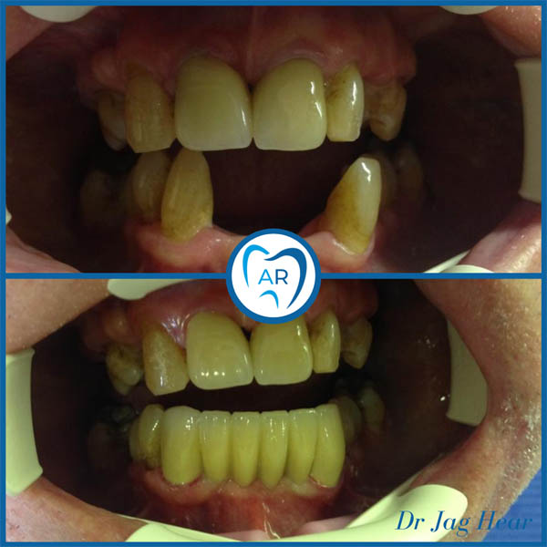 Emax Bridge Before & After 1 Walsall