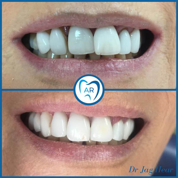 Emax Veneers Before & After 1 Walsall