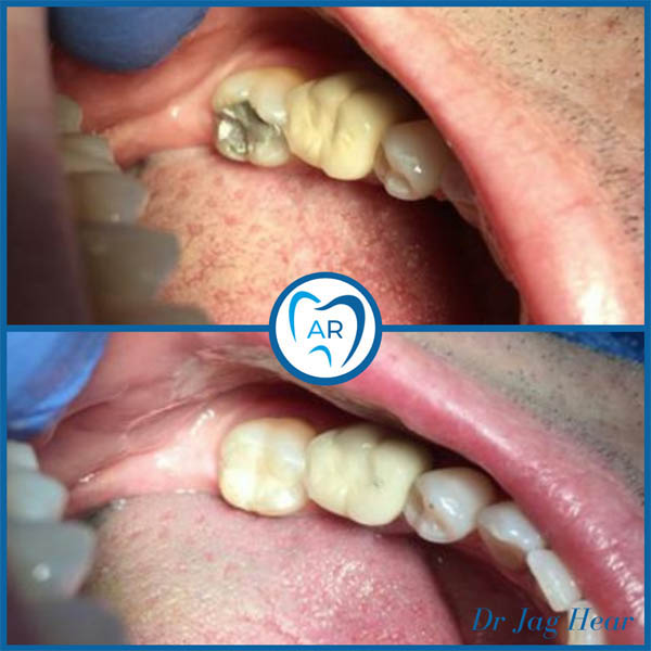 Dental Implant before and after 2 Walsall