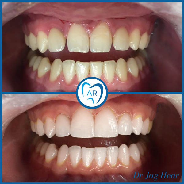 Porcelain Veneers Before & After 1