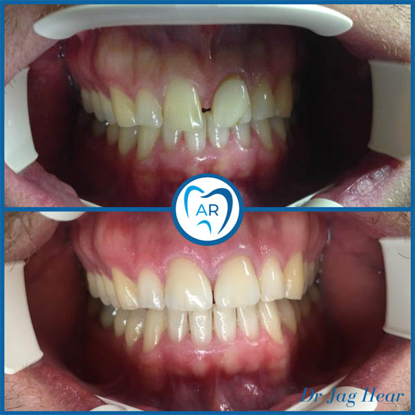 Porcelain Veneers Before and after 2 Walsall