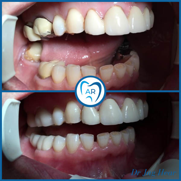 Replacing Old Crowns Before & After 1 Walsall