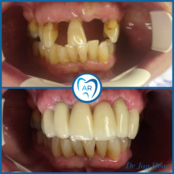 Smile makeover before and after 1