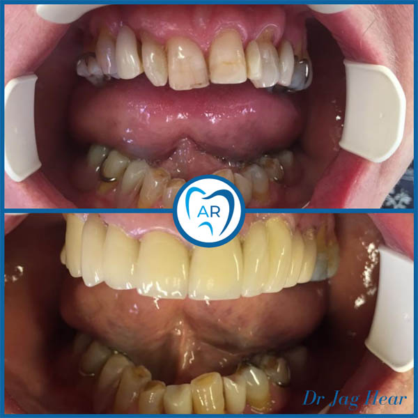 Smile makeover before and after 3