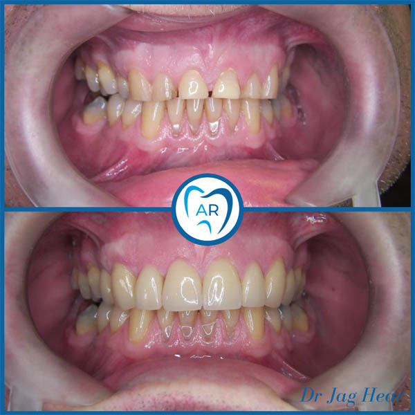 Smile makeover before and after 4