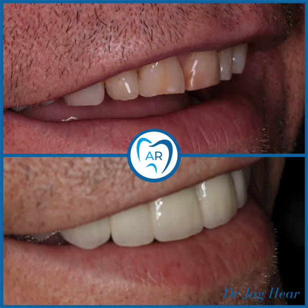 Smile makeover before and after 5