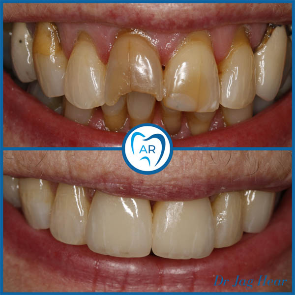 Smile Makeover Before & After 3