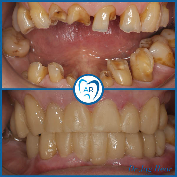 Smile Makeover Before & After