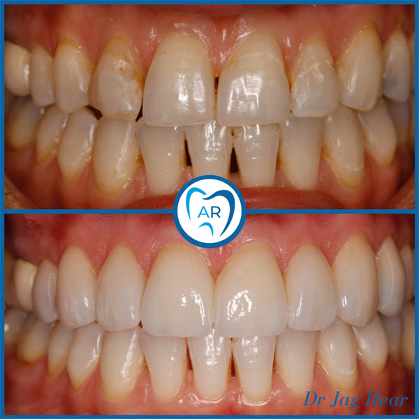 Dental Veneers Smile Makeover Walsall Before & After 1