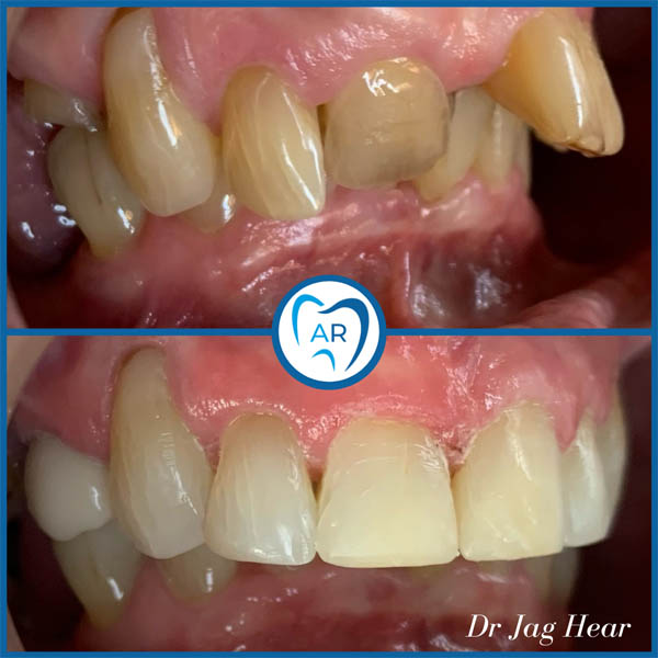 Fast braces before and after 2