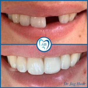 implants-before-and-after
